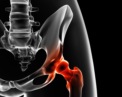 Zlomenina bez varování? Osteoporóza se týká i třicátníků