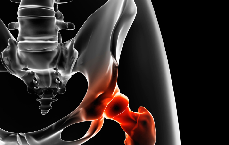 Zlomenina bez varování? Osteoporóza se týká i třicátníků