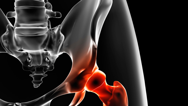 Zlomenina bez varování? Osteoporóza se týká i třicátníků